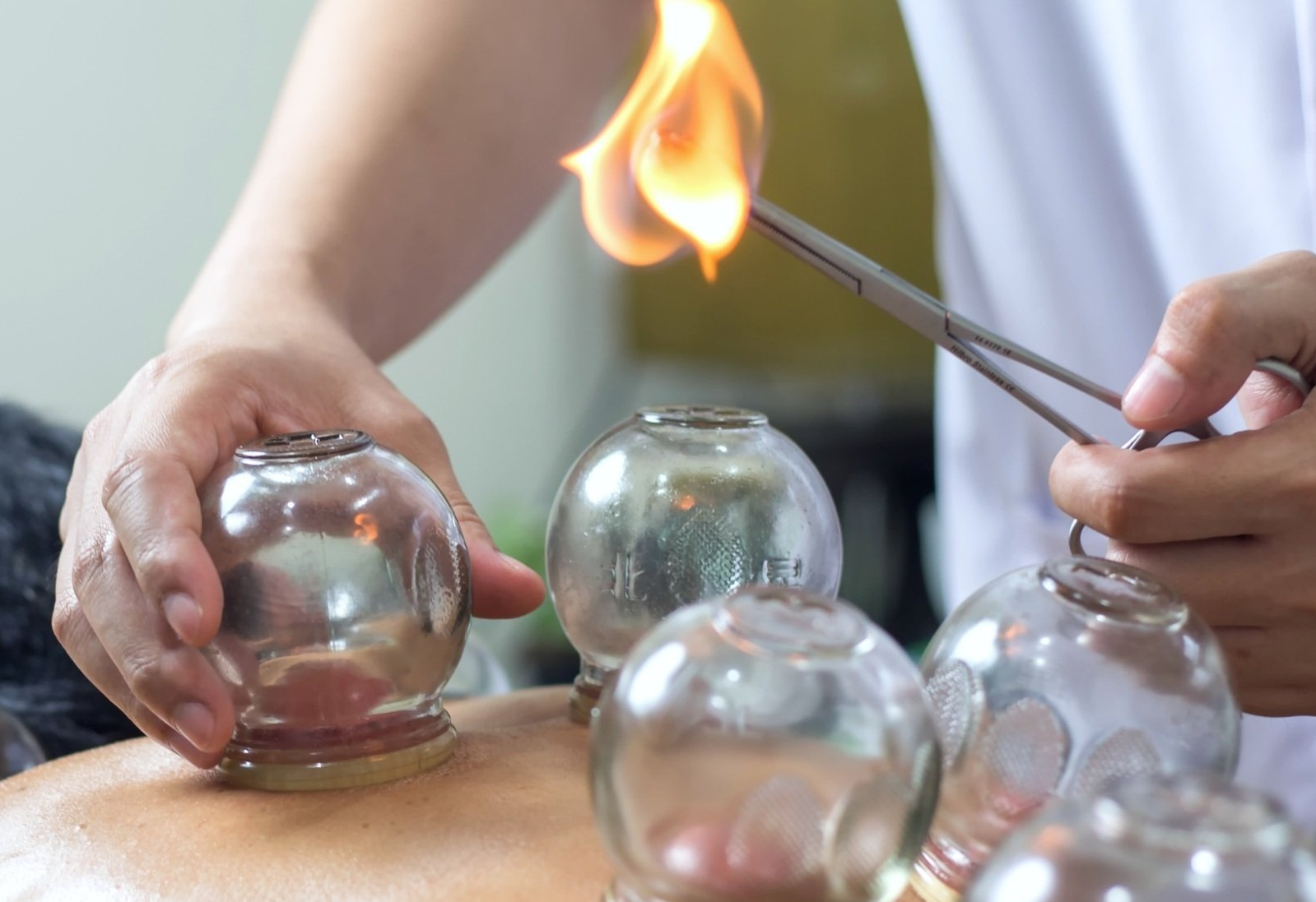 Fire Cupping Therapy